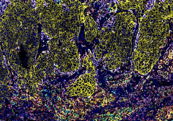 Hallmarks of Cancer: Understanding How Tumors Avoid Immune Destruction