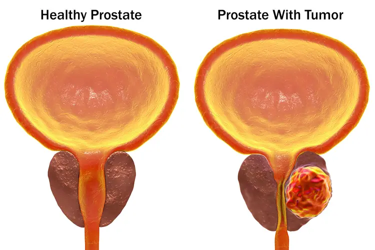 Webinar: Resolve Oncology Biomarkers and Spatially Map Diversity in Prostate Cancer TME